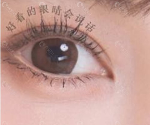 张桦做双眼皮好吗