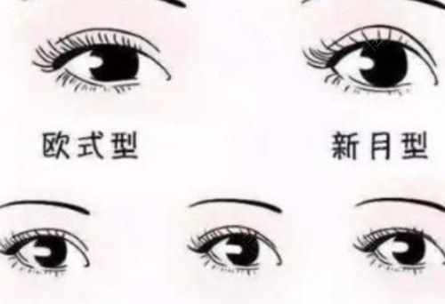 修志夫做双眼皮怎么样