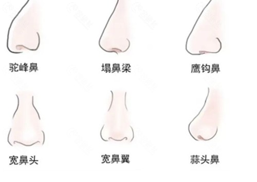 贾德渊隆鼻好吗