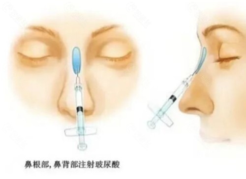 李付奎隆鼻手术好吗