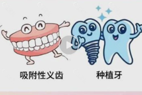 吸附性义齿和种植牙哪个好