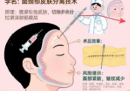 张林宏做拉皮手术怎么样
