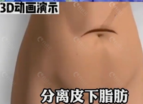 孙家明做腹壁整形好吗
