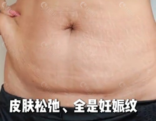 汪成做腹壁整形怎么样