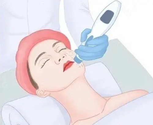 全脸除皱一般需要做几发？