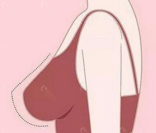 花6万做假体隆胸，值不值？