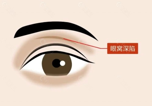 眼窝凹陷做脂肪填充好吗