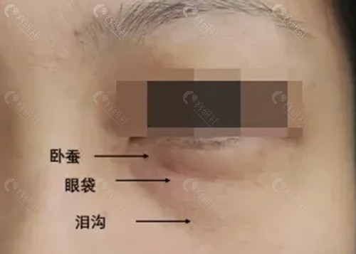 衢州颜芙医疗美容去眼袋好吗