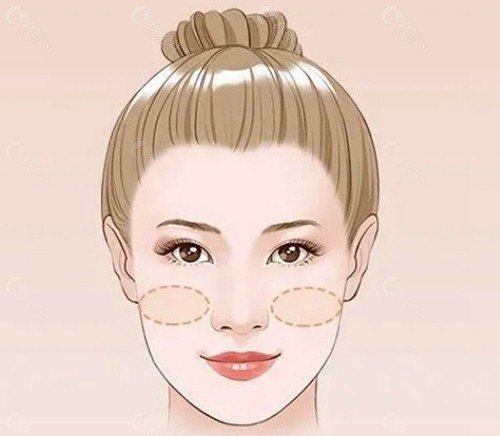 手术类提升（中重度松弛、作用持久）
