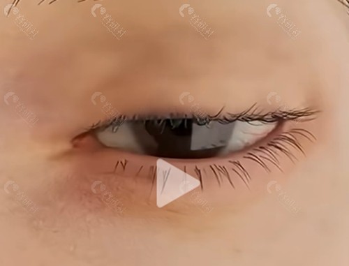 上眼皮下垂做什么手术好