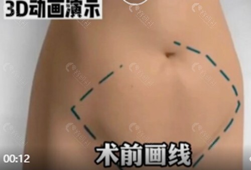 郑子良医生做腹壁整形好吗