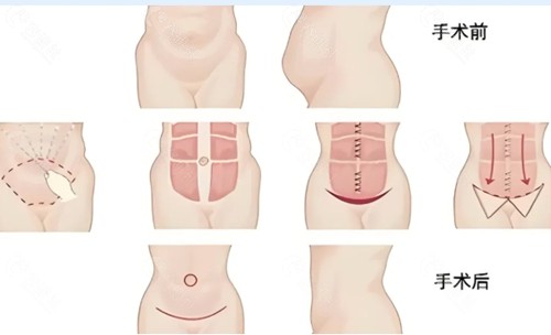 邢汉银医生做腹壁整形怎么样