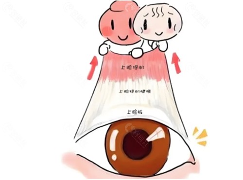 雙眼皮提肌高了可以修復嗎？