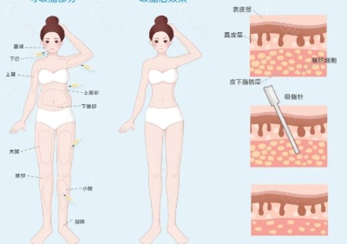程志军医生吸脂怎么样