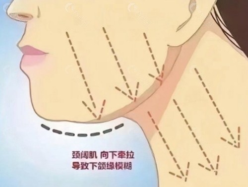 颈阔肌捆绑和下颌缘提升费用大概是多少？