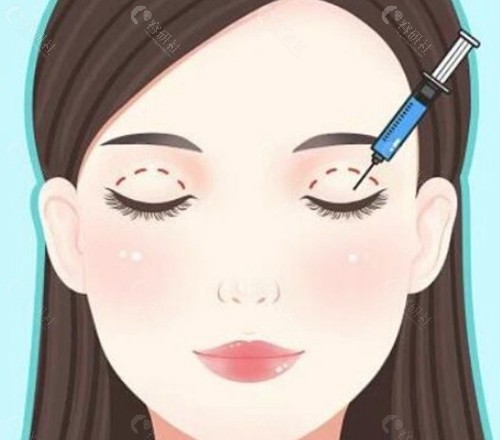 剛做完雙眼皮閉不上眼正常嗎？