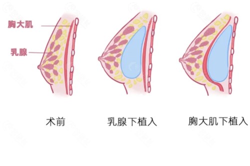 翟红宇医生隆胸怎么样