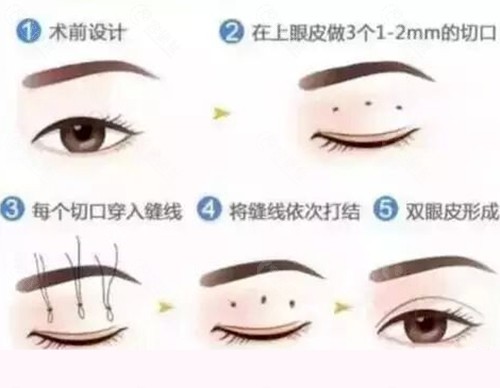 李三勇医生割双眼皮好吗