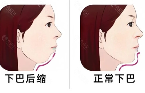 下巴后缩打玻尿酸有用吗