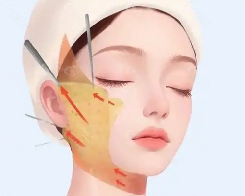 面部松弛下垂做完真的有用吗？