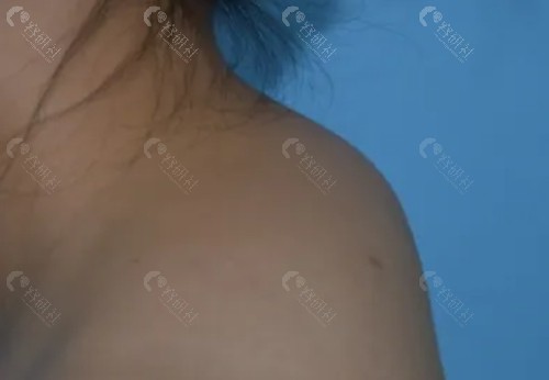 李方伟治疗富贵包怎么样