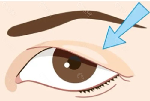 眼皮下垂可以做双眼皮手术吗