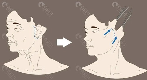1. 穆宝安：深层V美减龄技术好