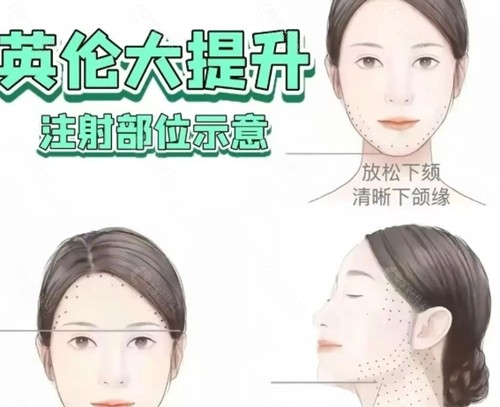 英伦大提升是什么医美项目 英伦大提升是什么医美项目