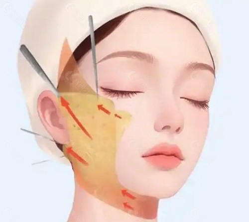 北京李晓东PSV面部提升和PST提升一样吗？