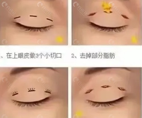 潍坊双华割双眼皮好吗