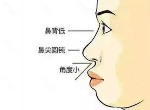 peek材料填充鼻基底价格 peek材料填充鼻基底价格