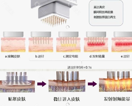 韩国打黄金微针医院