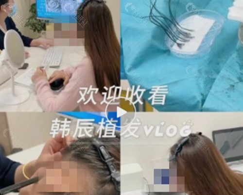 嘉兴韩辰治疗脱发好吗
