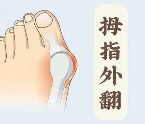 乌鲁木齐拇外翻手术哪位医生好