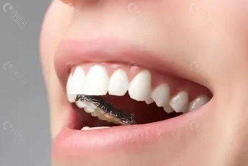 罗明医生牙齿矫正怎么样