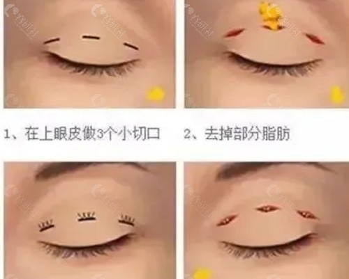 伊宁芳哗割双眼皮好吗