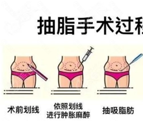 邯郸姣点医疗美容吸脂好吗