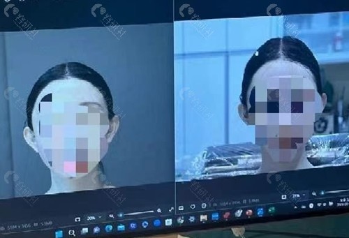 高颅顶和低颅顶对比图