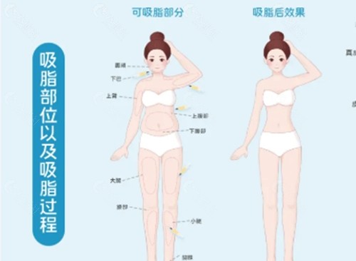 舒彬吸脂手术好吗