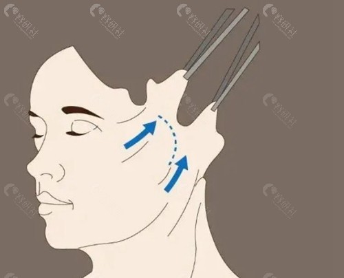 穆宝安现在年龄大了还能做v美减龄手术吗？
