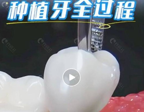 宜春泰康拜博口腔种植牙好吗