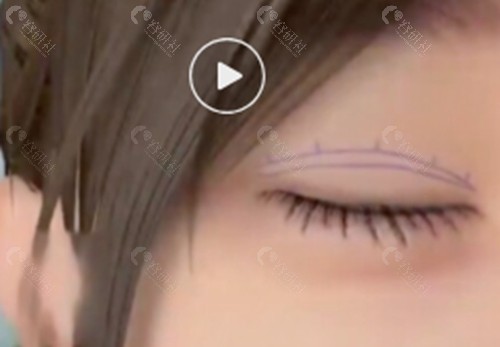 盘锦莱思美医疗美容割双眼皮好吗