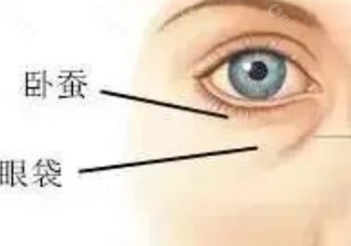 眼袋是抽脂好还是手术切除好？