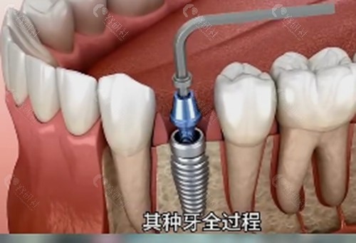 咸宁平头牙匠牙科种植牙怎么样 咸宁平头牙匠牙科种植牙怎么样