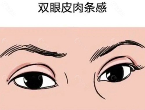 术后8个月还有肉条，是“没消肿”还是“做坏了”？