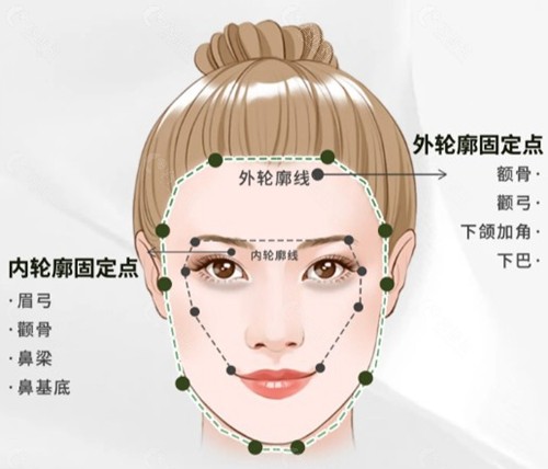 輪廓固定打什麼玻尿酸比較好？