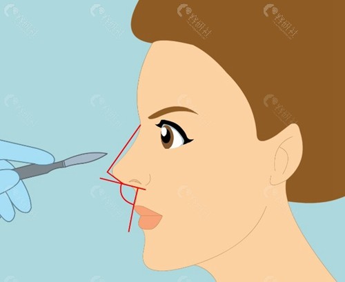 徐永丰做肋骨鼻怎么样？