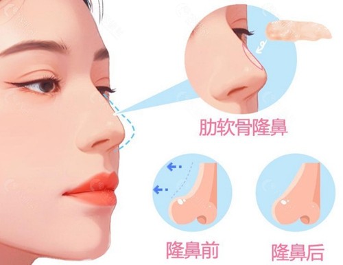 技术特色：为什么他的肋骨鼻能卖高价？