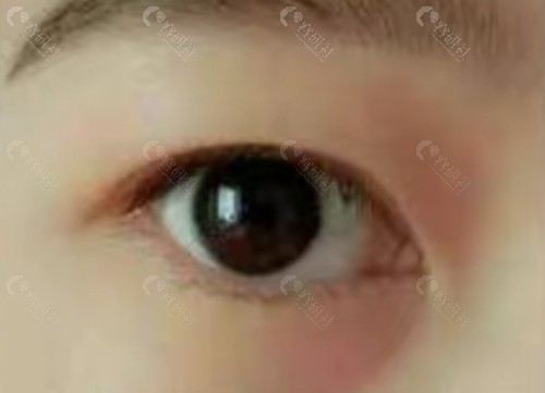 内双有必要割双眼皮吗