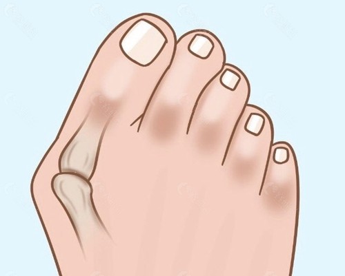 苏敬达：注重“大脚骨”综合精细化矫正